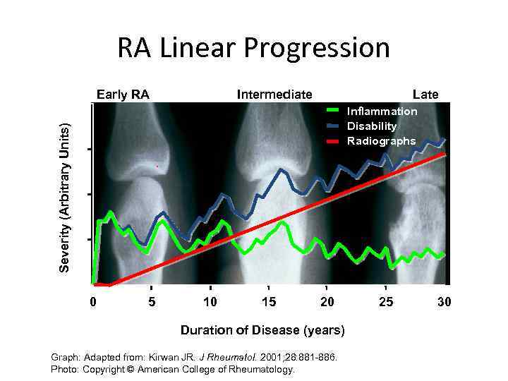RA Linear Progression Early RA Intermediate Late Severity (Arbitrary Units) Inflammation Disability Radiographs 0