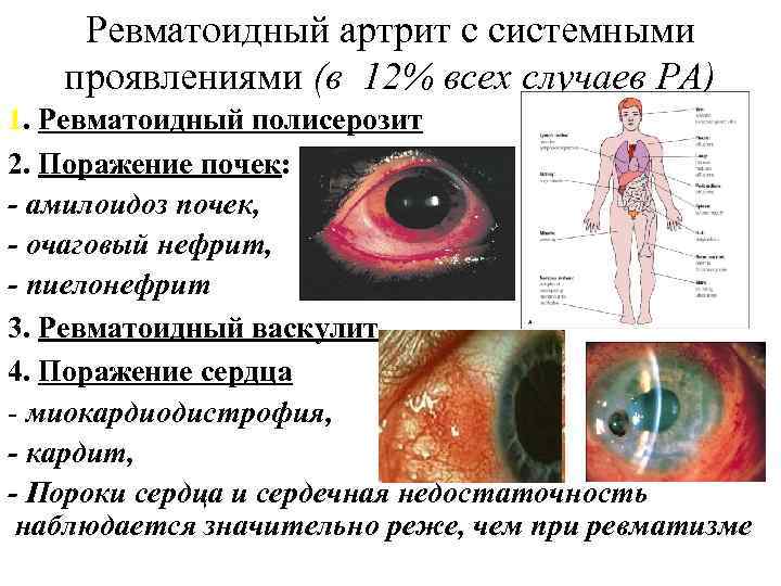 Ревматоидный артрит с системными проявлениями (в 12% всех случаев РА) 1. Ревматоидный полисерозит 2.