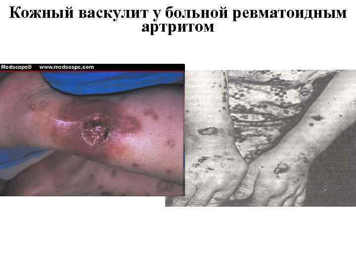 Кожный васкулит у больной ревматоидным артритом 
