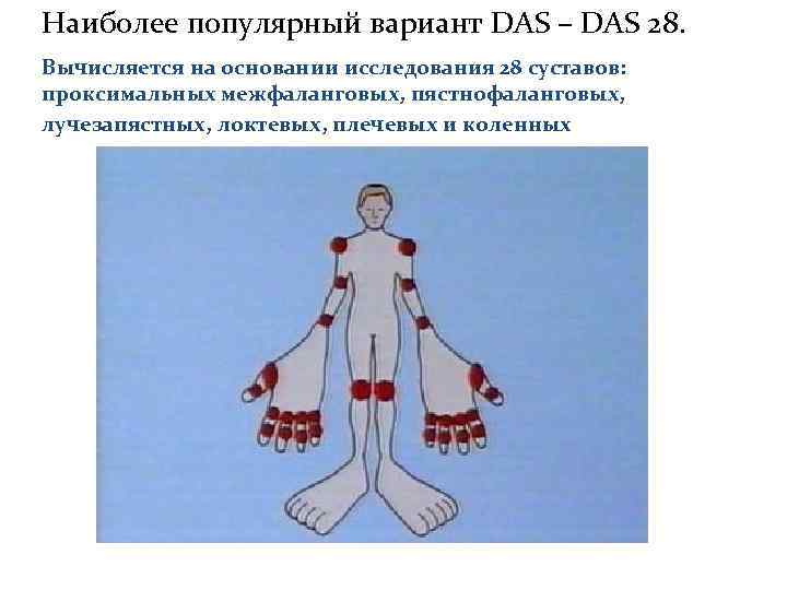 Наиболее популярный вариант DAS – DAS 28. Вычисляется на основании исследования 28 суставов: проксимальных