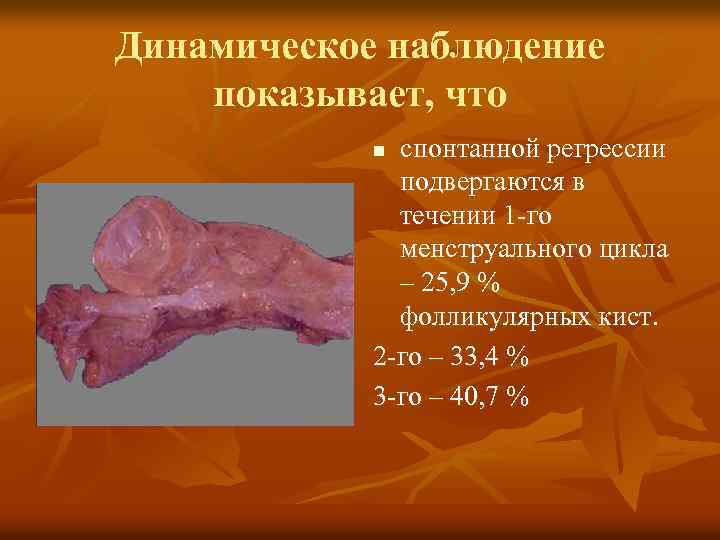 Динамическое наблюдение показывает, что спонтанной регрессии подвергаются в течении 1 -го менструального цикла –