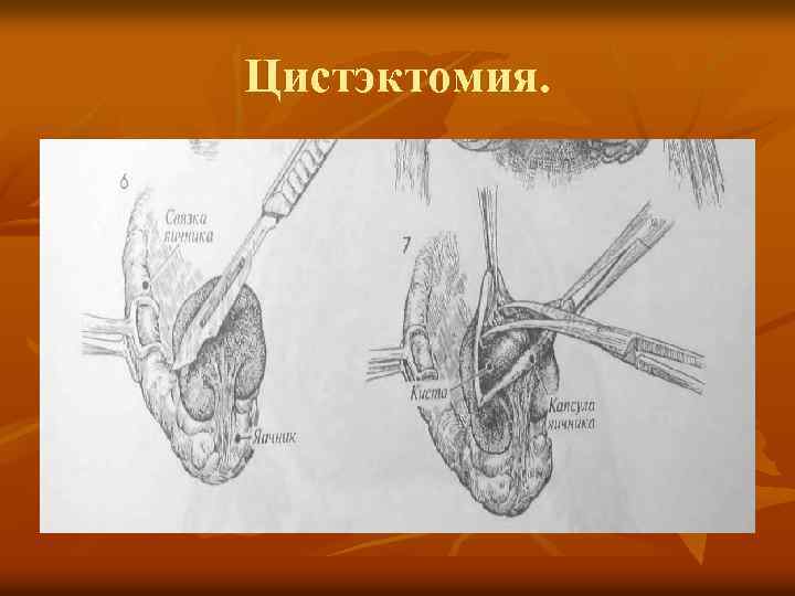 Цистотомия и цистэктомия