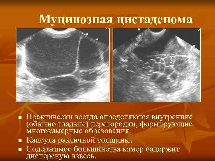 Муцинозная цистаденома n n n Практически всегда определяются внутренние (обычно гладкие) перегородки, формирующие многокамерные