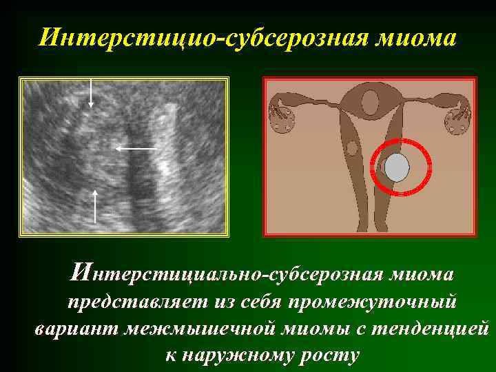 Миома на задней стенке матки