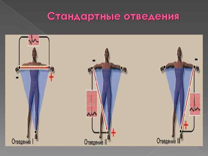 Стандартные отведения 