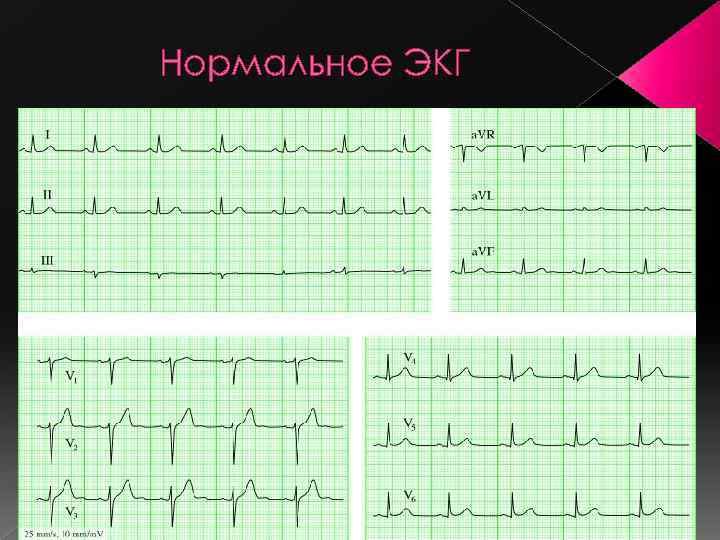 Нормальное ЭКГ 