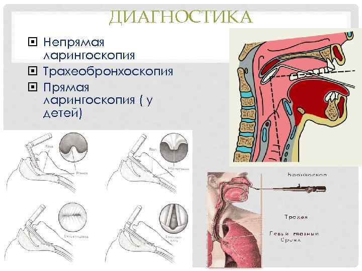 ДИАГНОСТИКА Непрямая ларингоскопия Трахеобронхоскопия Прямая ларингоскопия ( у детей) 