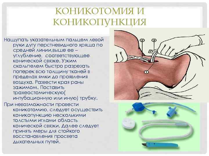 КОНИКОТОМИЯ И КОНИКОПУНКЦИЯ Нащупать указательным пальцем левой руки дугу перстневидного хряща по средней линии,