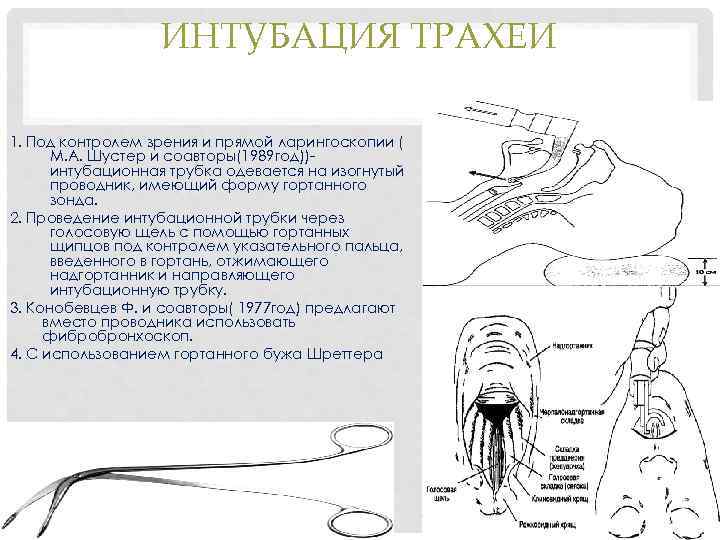 ИНТУБАЦИЯ ТРАХЕИ 1. Под контролем зрения и прямой ларингоскопии ( М. А. Шустер и