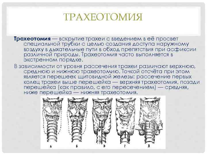 ТРАХЕОТОМИЯ Трахеотомия — вскрытие трахеи с введением в её просвет специальной трубки с целью