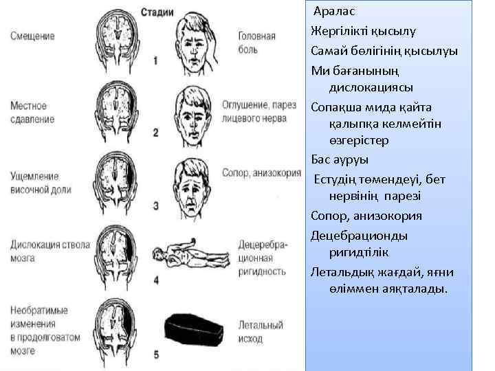 Аралас Жергілікті қысылу Самай бөлігінің қысылуы Ми бағанының дислокациясы Сопақша мида қайта қалыпқа келмейтін