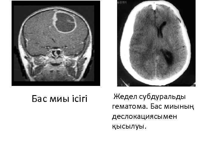 Бас миы ісігі Жедел субдуральды гематома. Бас миының деслокациясымен қысылуы. 