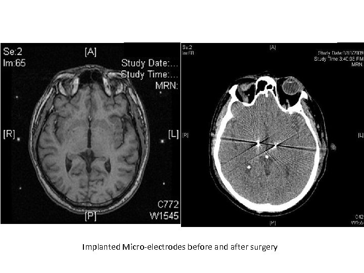 Implanted Micro-electrodes before and after surgery 