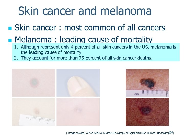 Skin cancer and melanoma Skin cancer : most common of all cancers n Melanoma