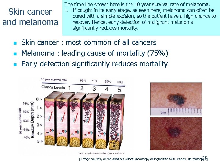 Skin cancer and melanoma n n n The time line shown here is the