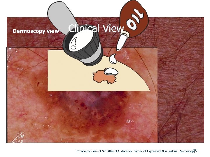 Dermoscopy view Clinical View 26 [ Image courtesy of “An Atlas of Surface Microscopy