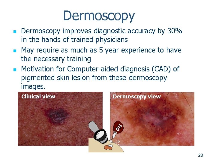 Dermoscopy n n n Dermoscopy improves diagnostic accuracy by 30% in the hands of