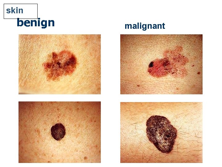 skin benign malignant 