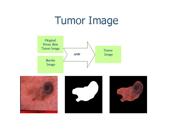 Tumor Image Original Noisy Skin Tumor Image AND Border Image Tumor Image 