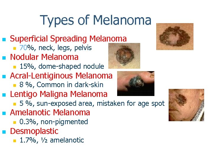 Types of Melanoma n Superficial Spreading Melanoma n n Nodular Melanoma n n 5