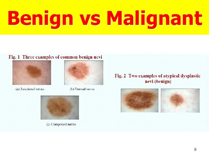 Benign vs Malignant 9 