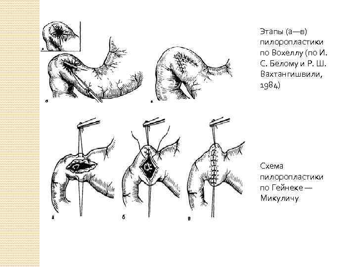 Пилоропластика по финнею схема