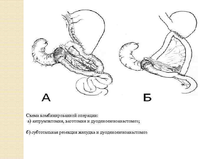 Резекция желудка по витебскому схема операции
