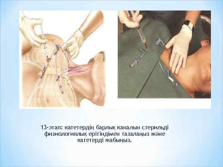 13 -этап: катетердің барлық каналын стерильді физиологиялық ерітіндімен тазалаңыз және катетерді жабыңыз. 