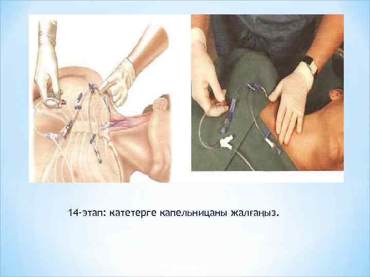14 -этап: катетерге капельницаны жалғаңыз. 