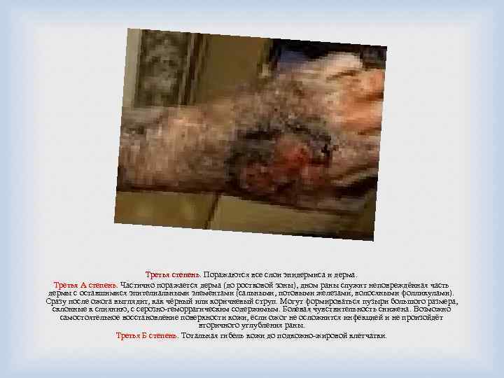 Третья степень. Поражаются все слои эпидермиса и дерма. Третья А степень. Частично поражается дерма