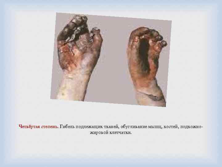 Четвёртая степень. Гибель подлежащих тканей, обугливание мышц, костей, подкожножировой клетчатки. 