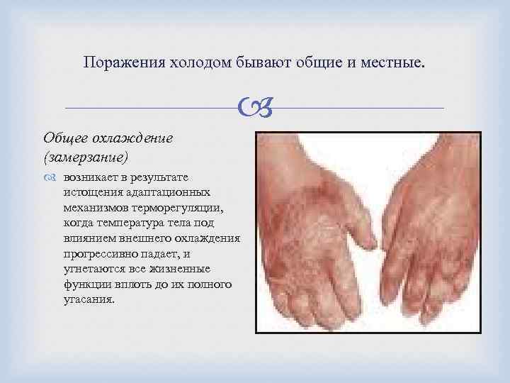 Поражения холодом бывают общие и местные. Общее охлаждение (замерзание) возникает в результате истощения адаптационных