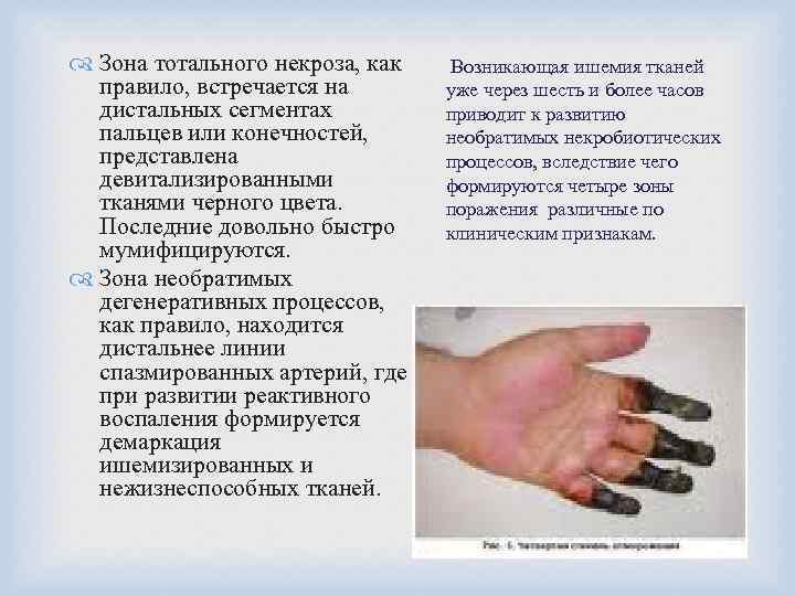  Зона тотального некроза, как правило, встречается на дистальных сегментах пальцев или конечностей, представлена