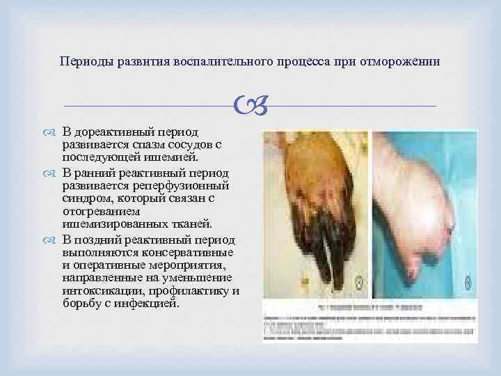 Периоды развития воспалительного процесса при отморожении В дореактивный период развивается спазм сосудов с последующей