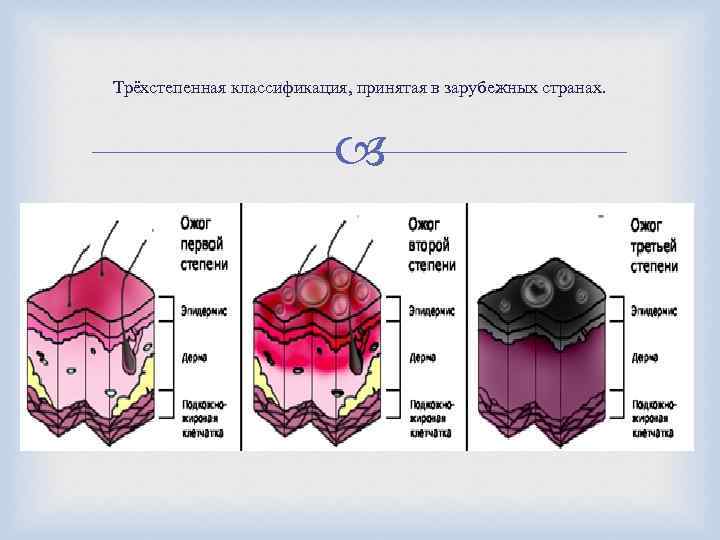 Трёхстепенная классификация, принятая в зарубежных странах. 