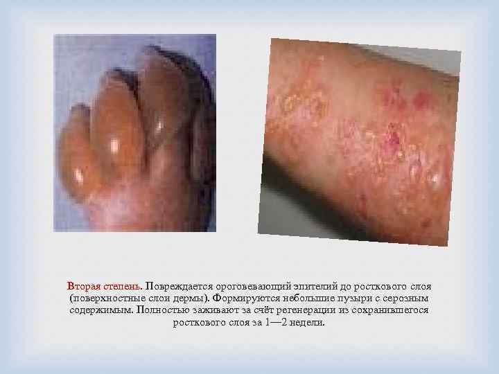Вторая степень. Повреждается ороговевающий эпителий до росткового слоя (поверхностные слои дермы). Формируются небольшие пузыри