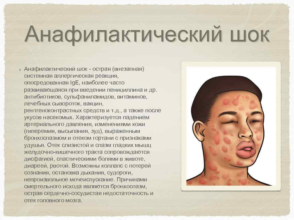 Анафилактический шок - острая (внезапная) системная аллергическая реакция, опосредованная Ig. E, наиболее часто развивающаяся