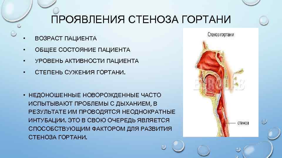 Стеноз гортани карта вызова