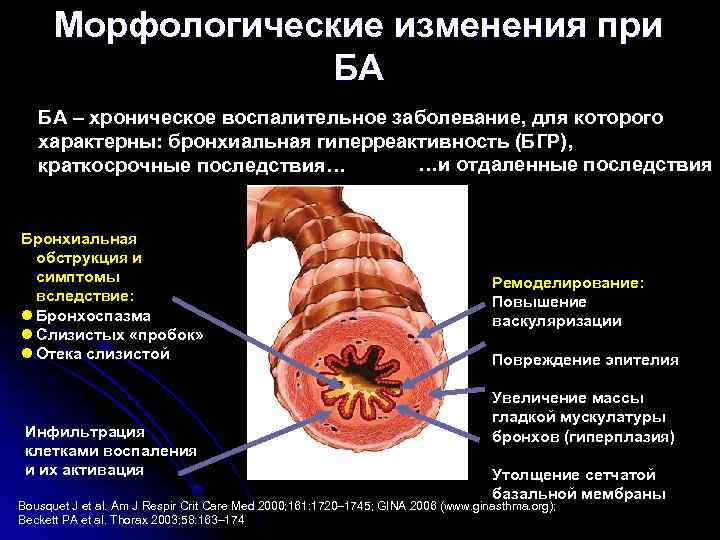 Морфологические изменения при БА БА – хроническое воспалительное заболевание, для которого характерны: бронхиальная гиперреактивность