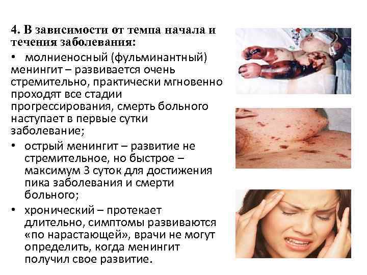 4. В зависимости от темпа начала и течения заболевания: • молниеносный (фульминантный) менингит –