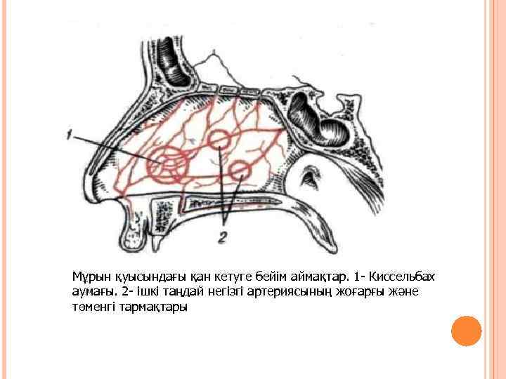 Мұрын қуысындағы қан кетуге бейім аймақтар. 1 - Киссельбах аумағы. 2 - ішкі таңдай