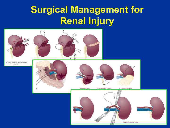 Surgical Management for Renal Injury 