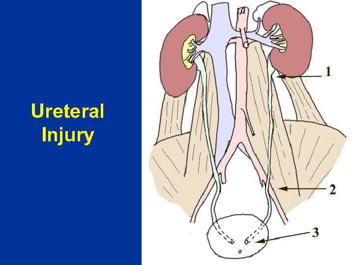 Ureteral Injury 