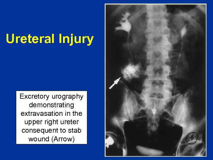 Ureteral Injury Excretory urography demonstrating extravasation in the upper right ureter consequent to stab