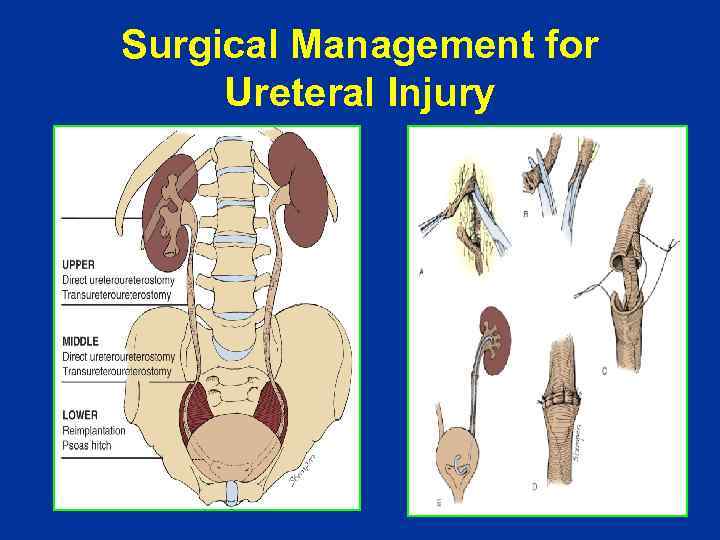 Surgical Management for Ureteral Injury 