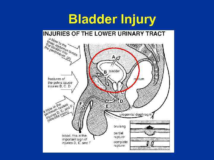 Bladder Injury 