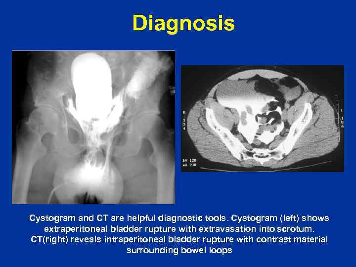 Diagnosis Cystogram and CT are helpful diagnostic tools. Cystogram (left) shows extraperitoneal bladder rupture