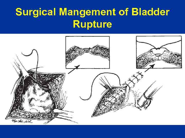 Surgical Mangement of Bladder Rupture 