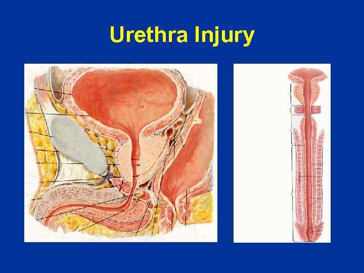 Urethra Injury 