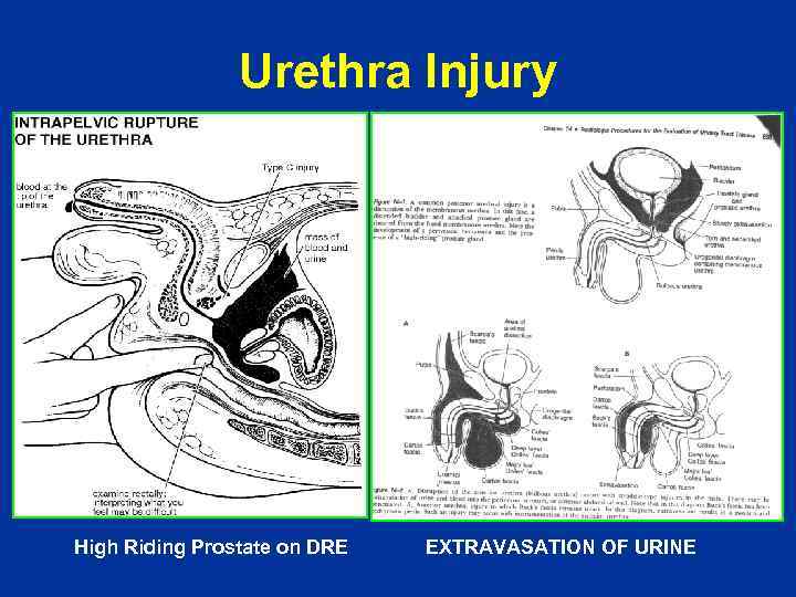 Urethra Injury High Riding Prostate on DRE EXTRAVASATION OF URINE 